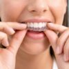 Clear Aligners – €150 Deposit
